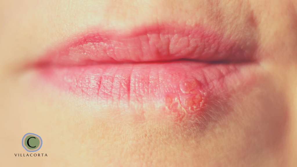 homeopathy for cold sores